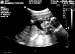 Fetus