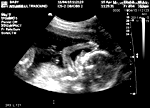 Fetus