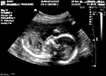 Fetus