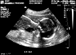 Fetus