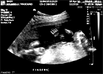 Fetus